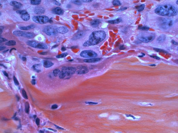 Mikroskopie von Tumorzellen in Blut